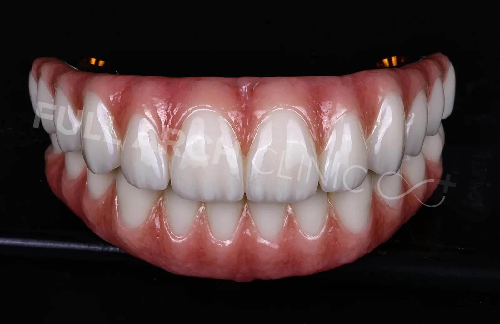 Both final arches, frontal view, on Ti-bases