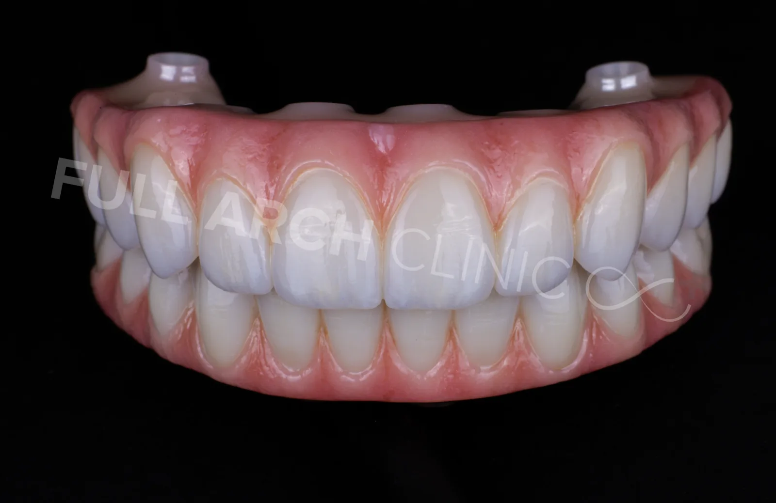 Monolithic zirconia full-arch prostheses, both arches