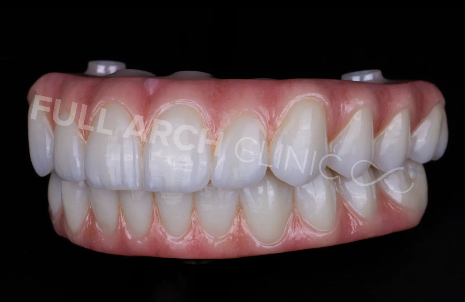 Both final arches in occlusion, lateral view