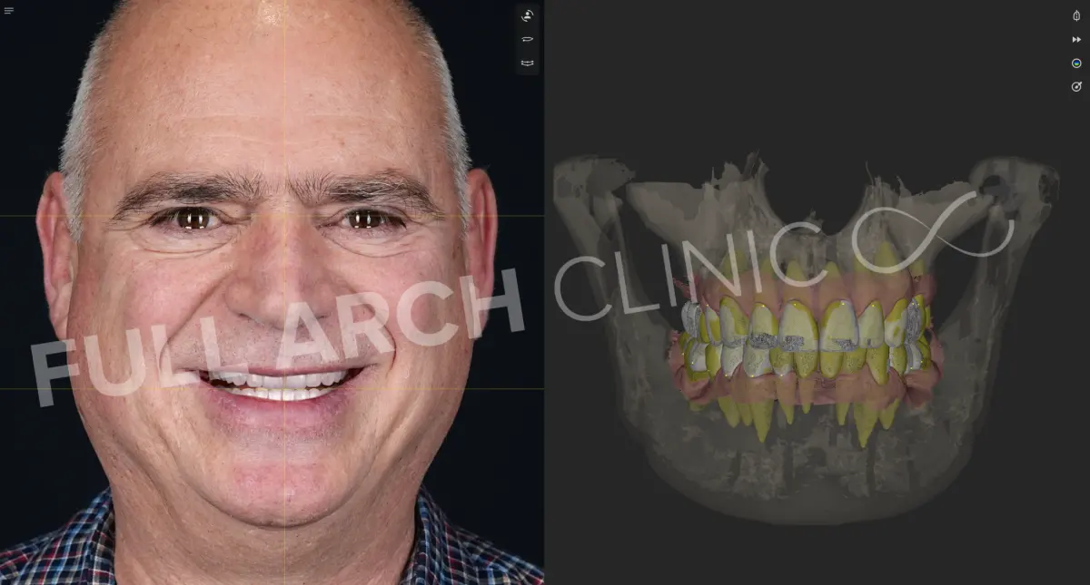 Patient smile and full-arch design over the CBCT in SmileCloud