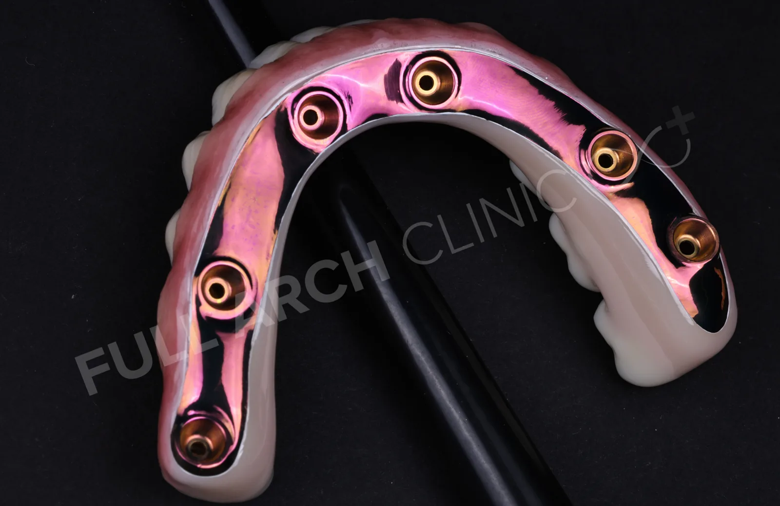 Polished underside of a milled titanium bar prosthesis
