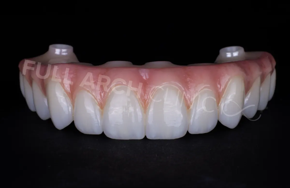 Monolithic zirconia upper arch prosthesis